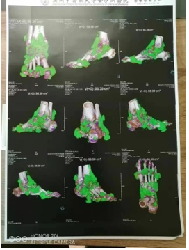 [四高]為何越來(lái)越多男人得痛風(fēng)？